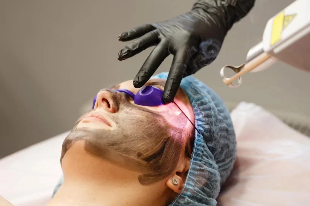 Carbon Laser Facial Treatment in Noida